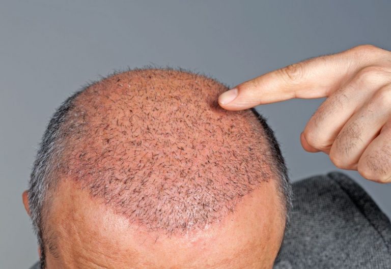 5 Steps of FUE Hair Transplantation